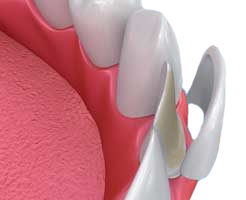 What are dental veneers