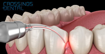 Laser Dentistry in San Diego