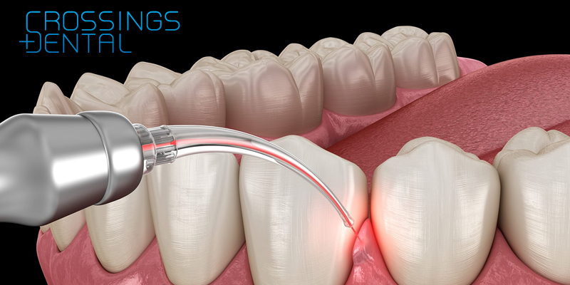 Laser Dentistry in San Diego